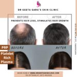 prp for hair