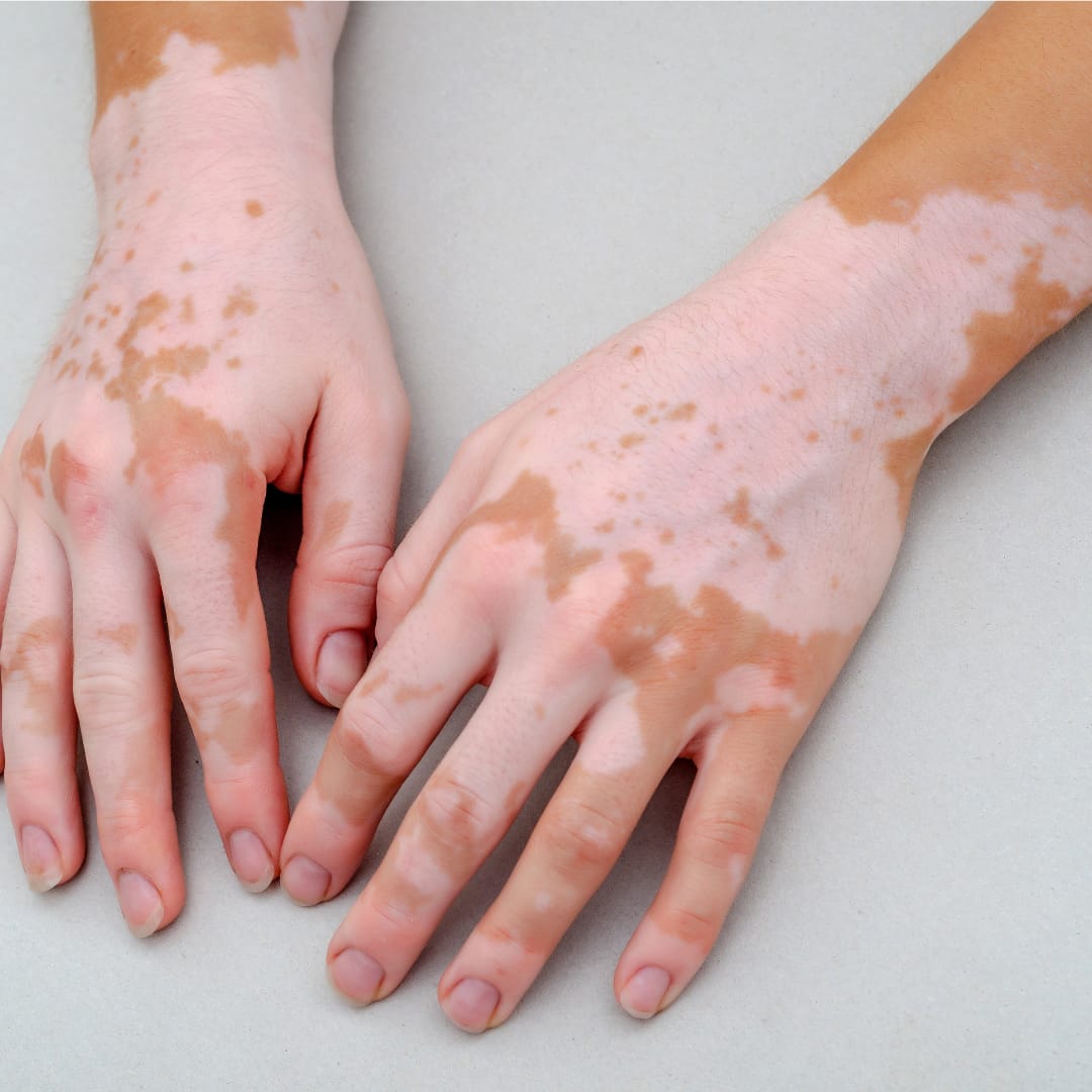 Skin treatment procedure