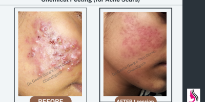 Chemical Peeling PrePost Chemical Peeling PrePost